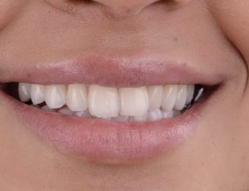 Estética dental